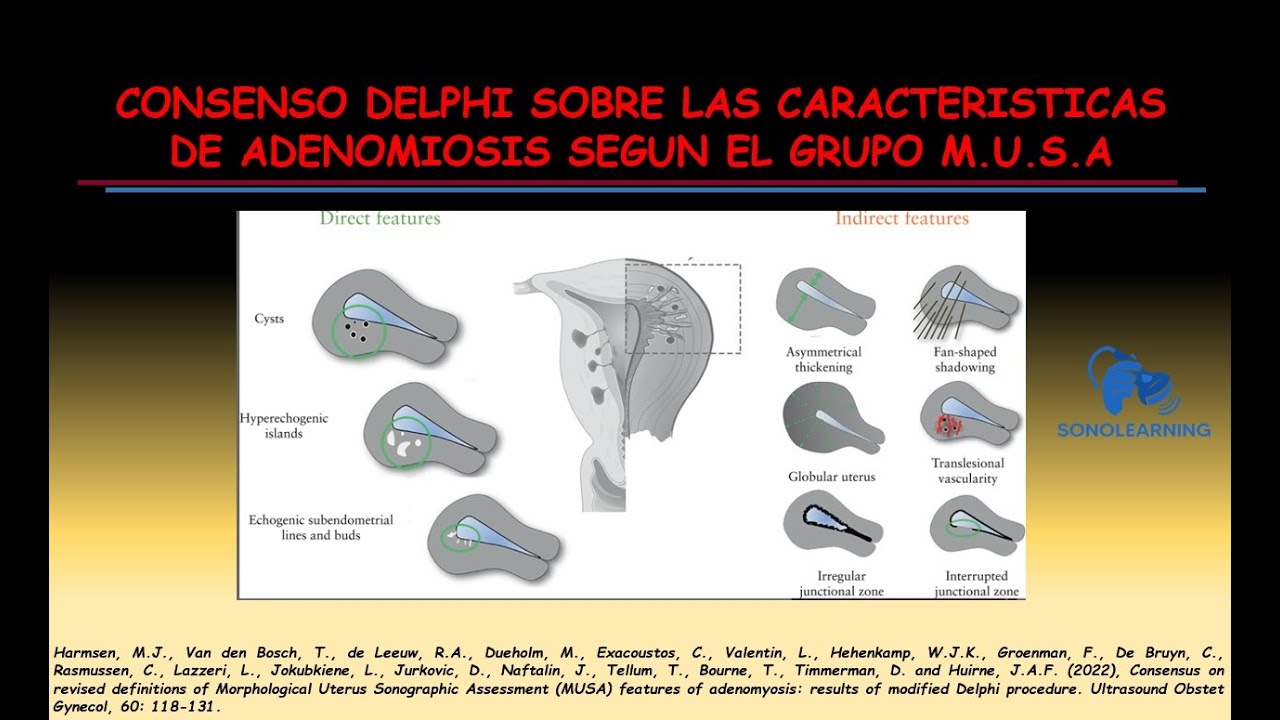 SIGNOS SUGESTIVOS DE ADENOMIOSIS