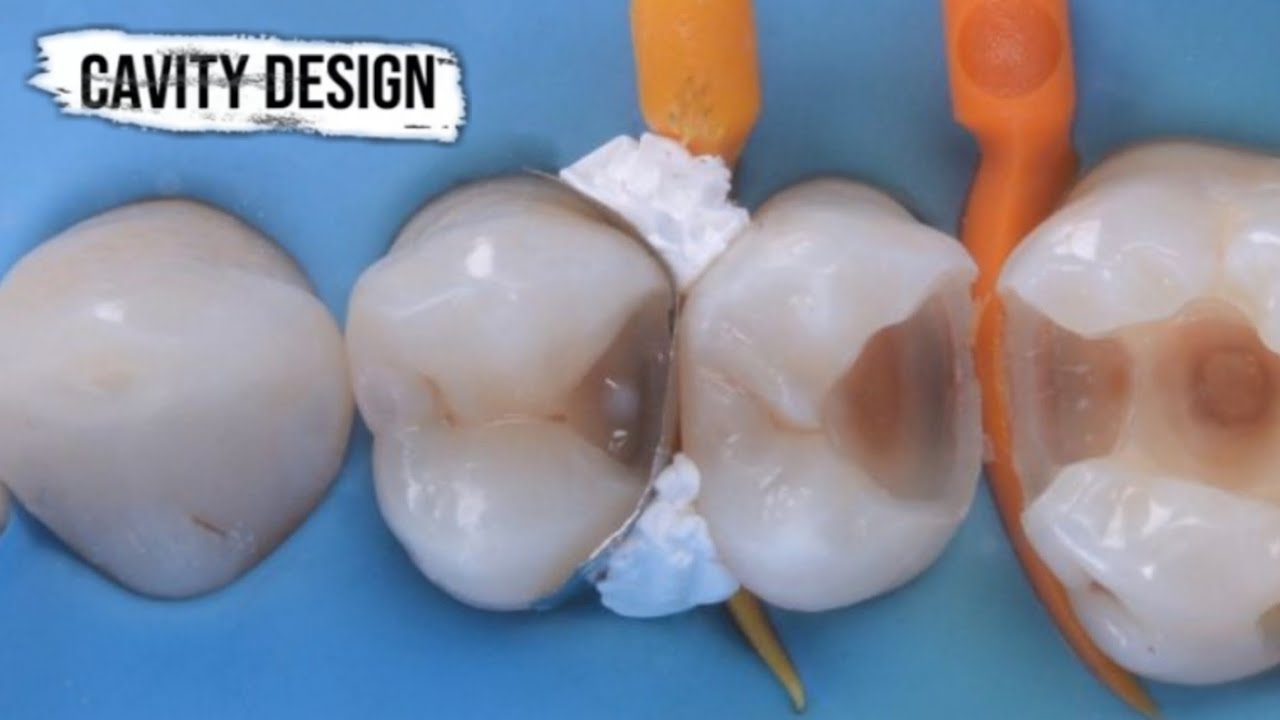 Cavity Design For Composite Restoration