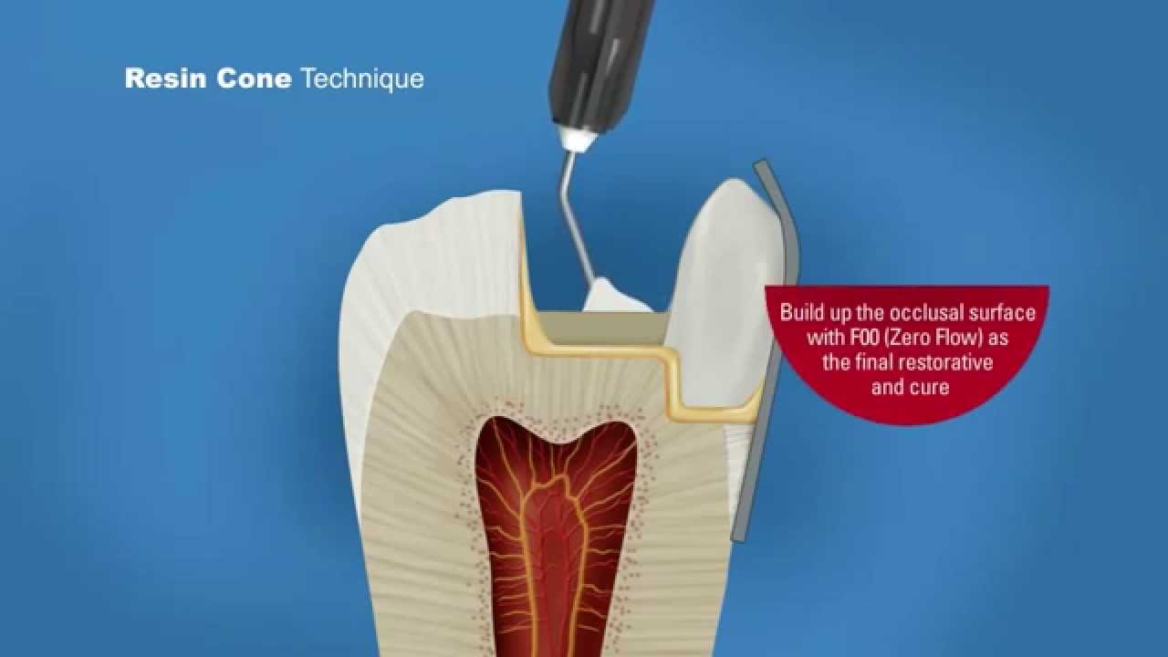 Beautifil II Resin Cone Technique Shofu