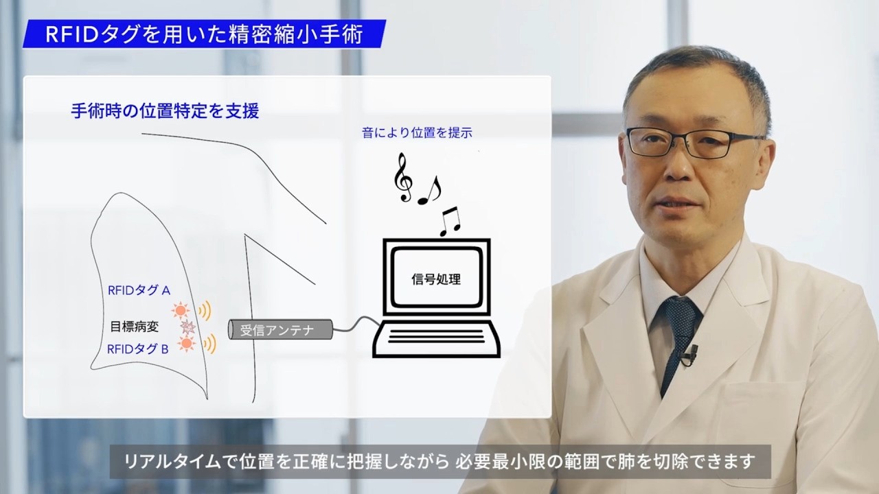 RFIDタグが変える肺がん手術 ー小型肺がんに挑む精密縮小手術ー