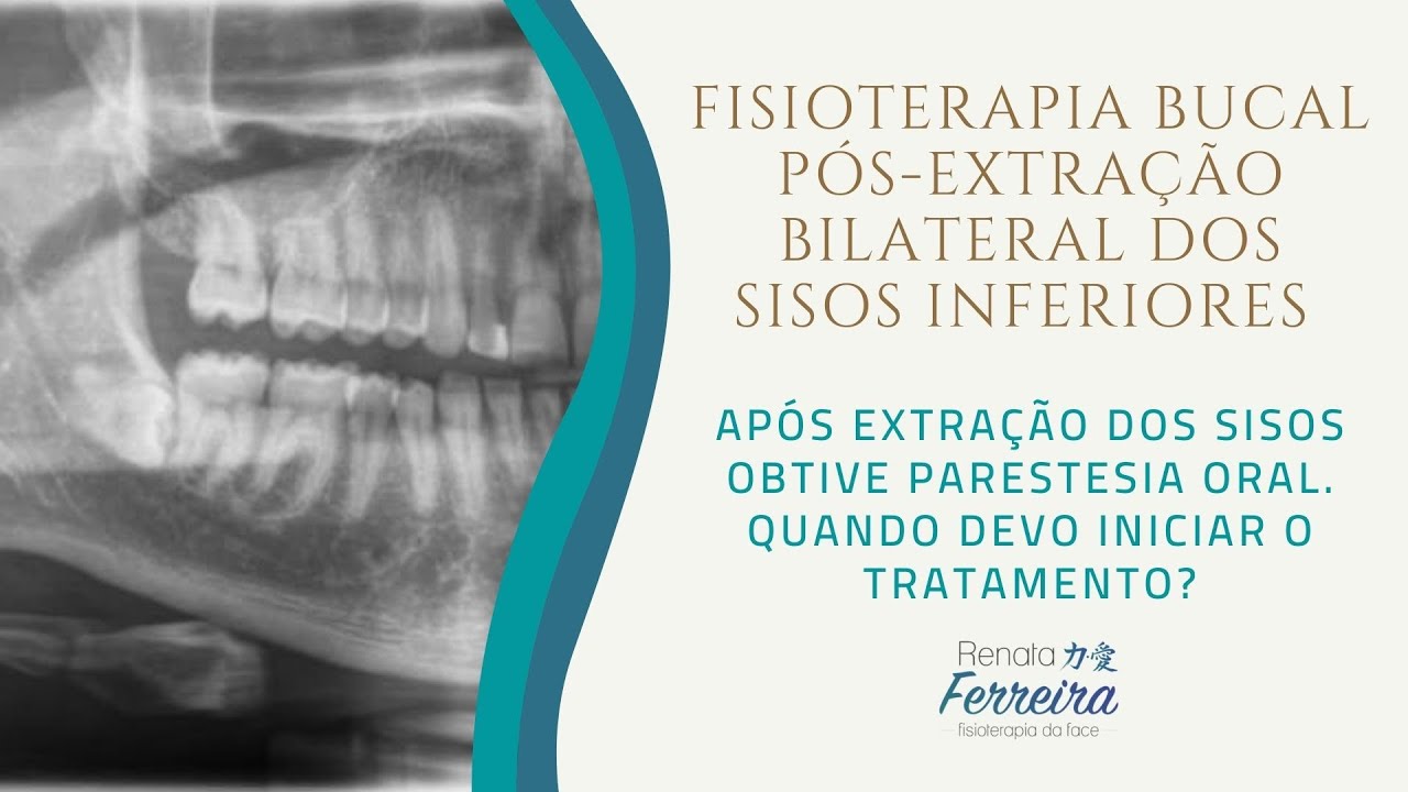 Ap&oacute;s extra&ccedil;&atilde;o bilateral dos sisos obtive parestesia oral. Quando devo iniciar o tratamento?