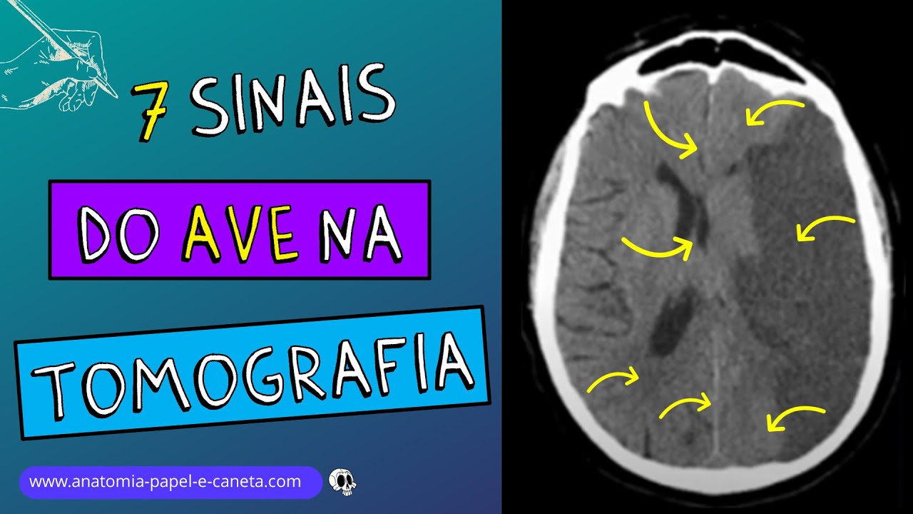 Os 7 sinais do AVE / AVC na Tomografia