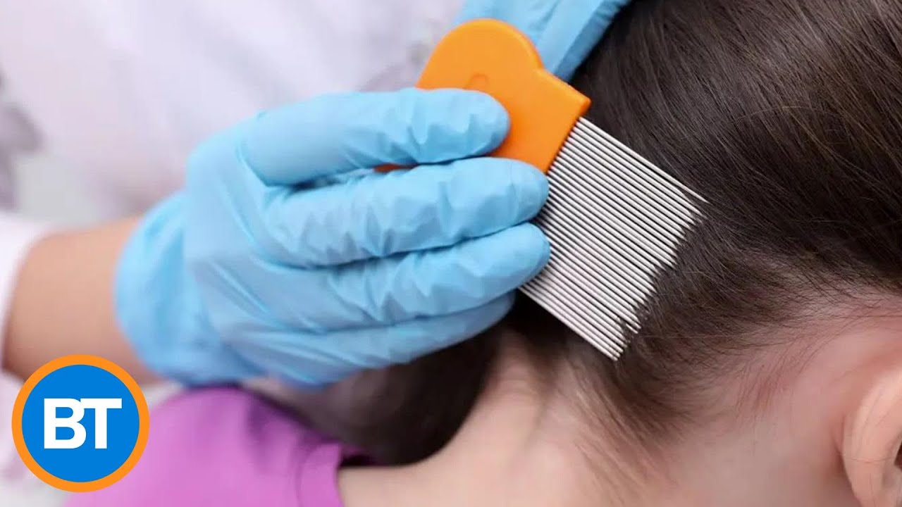 'Super Lice' is on the rise — here's how to treat it at home