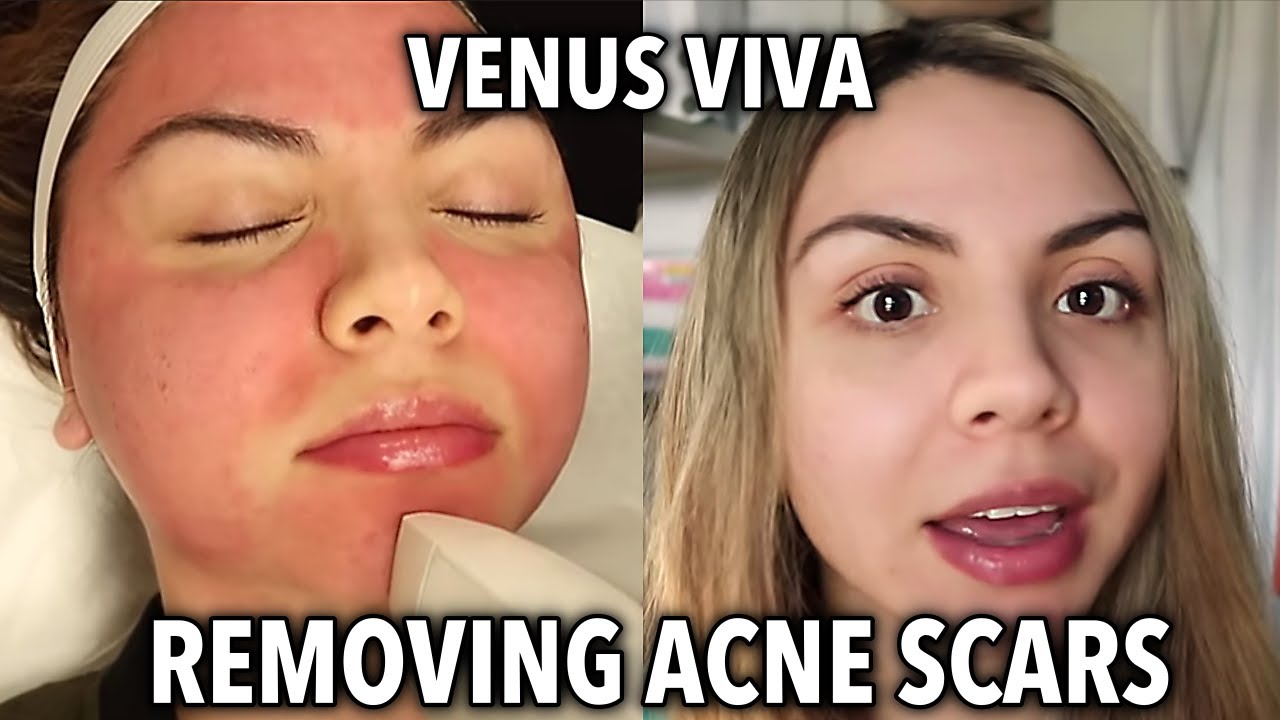 Skin Resurfacing Venus Viva Treatment For Acne Scars Vlog | Is it Better than a VI Peel?