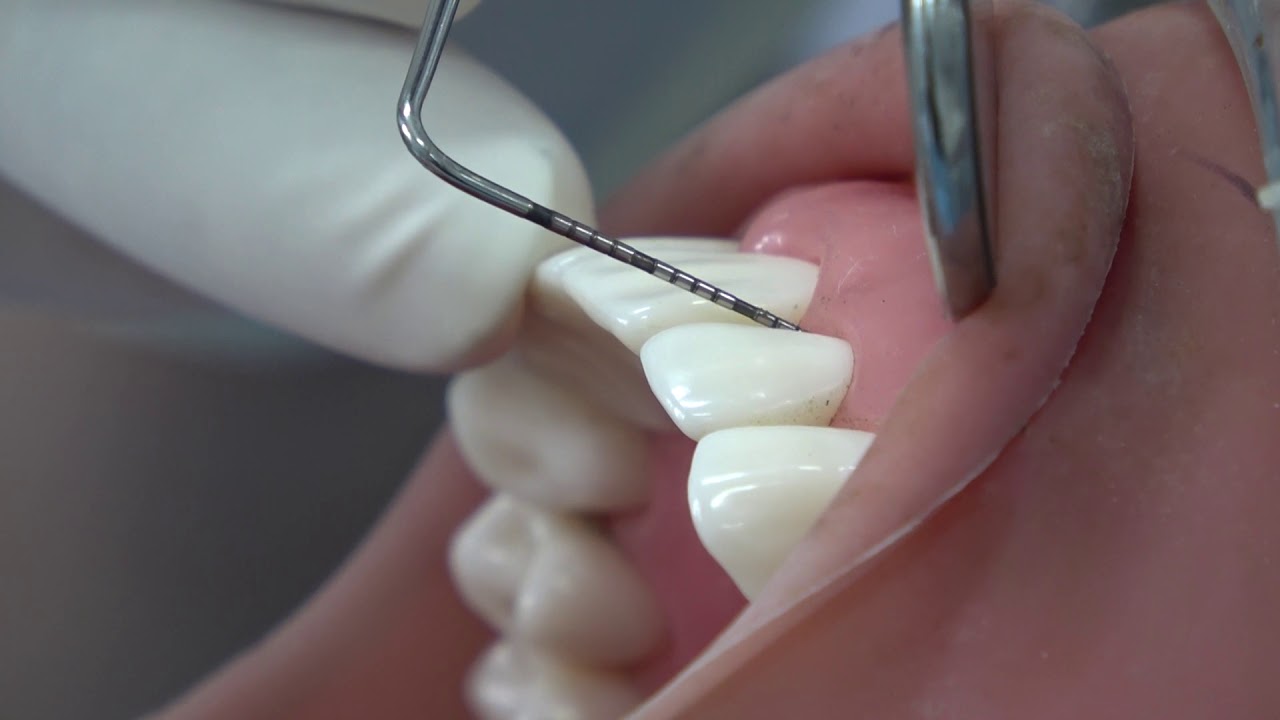 Pemeriksaan Objektif Jaringan Periodontal Bagian 2: Teknik Pemeriksaan Objektif