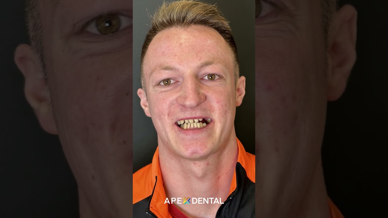 Hollywood Smile & Implant Treatment | Before - After