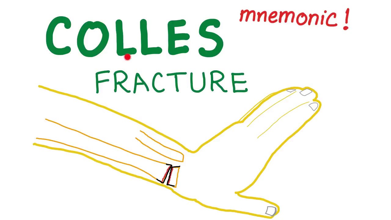 Colles Fracture Mnemonic - Orthopaedics
