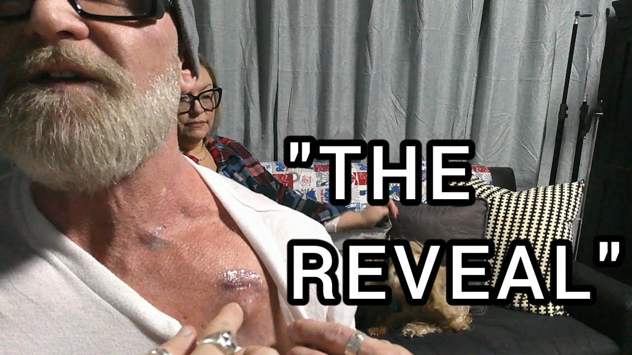 The Port Reveal: My Surgery Day & Recovery | STR8Mercer