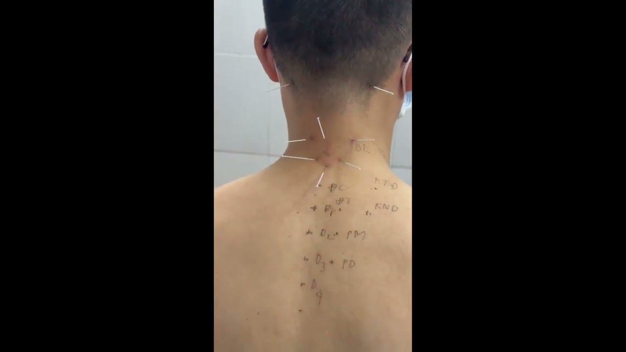 Châm cứu chữa hội chứng đau cổ vai tay do thoái hóa đốt sống cổ