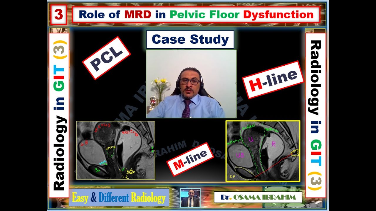 3 MR Defecography ( its role in pelvic floor dysfunction)