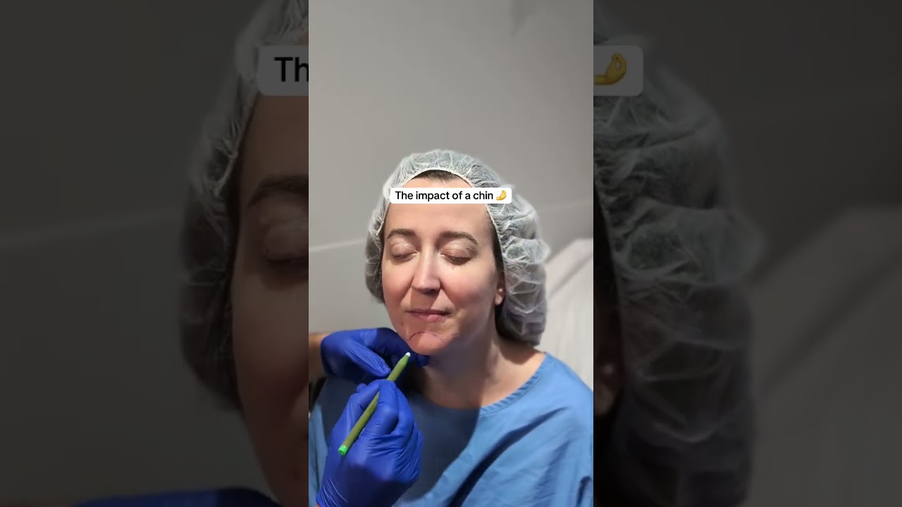 The secret to a defined jawline? Often, it's the chin! 📐