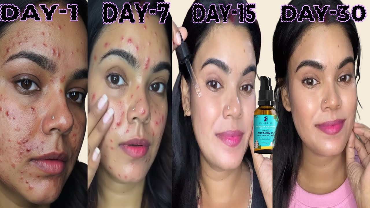 Pilgrim Vitamin C Serum Honest Review | 5 Days Skin Transformation | Before & After 