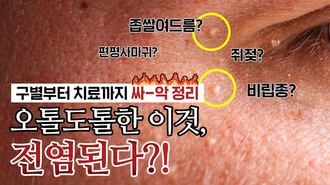 오톨도톨한 이것, 좁쌀여드름이 아니었다..?😨 (+🔥OOO는 작아도 바로 없애야 합니다🔥) - [언니네피부과]