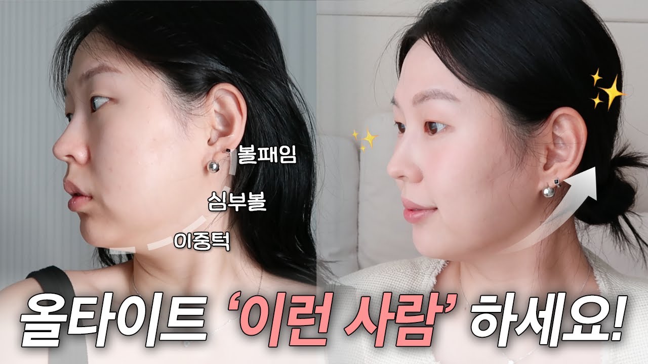 땅콩형+불독 얼굴🥜 딱 한번만 '올타이트 리프팅' | 전후비교, 통증있어요!, 효과 없나..?✨