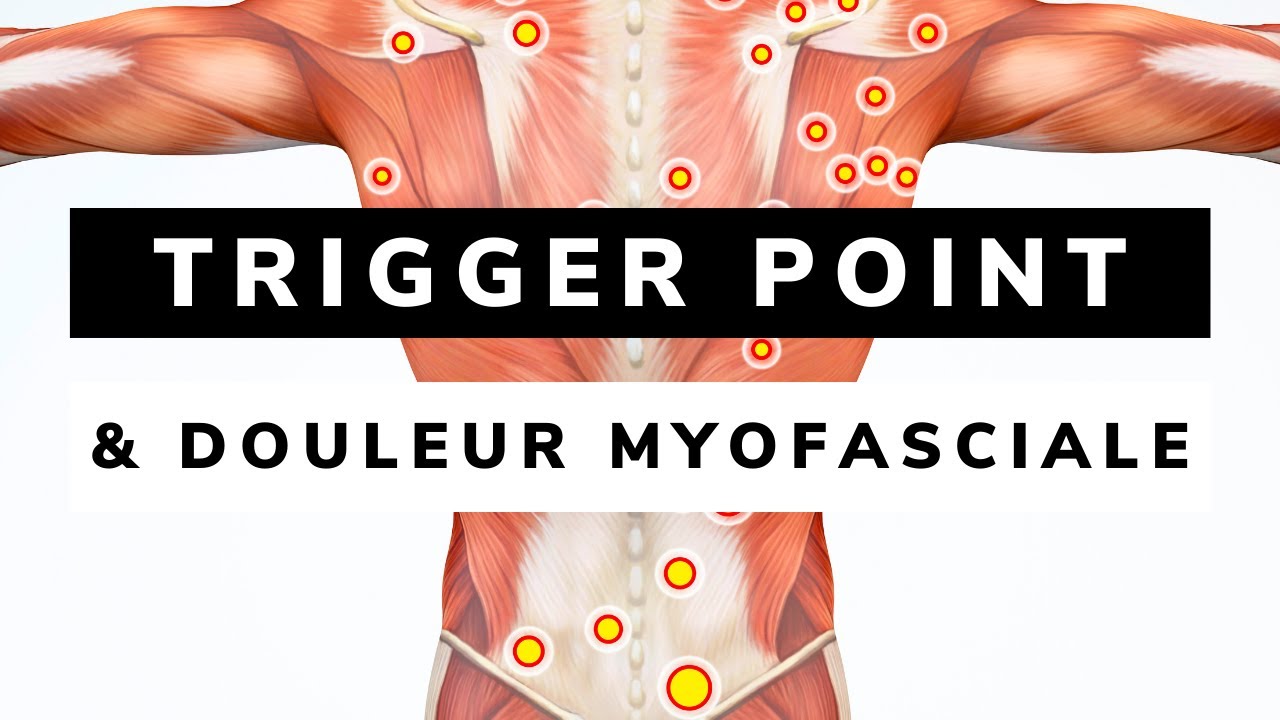 SYNDROME DE DOULEUR MYOFASCIALE et TRAITEMENT DES POINTS GACHETTES