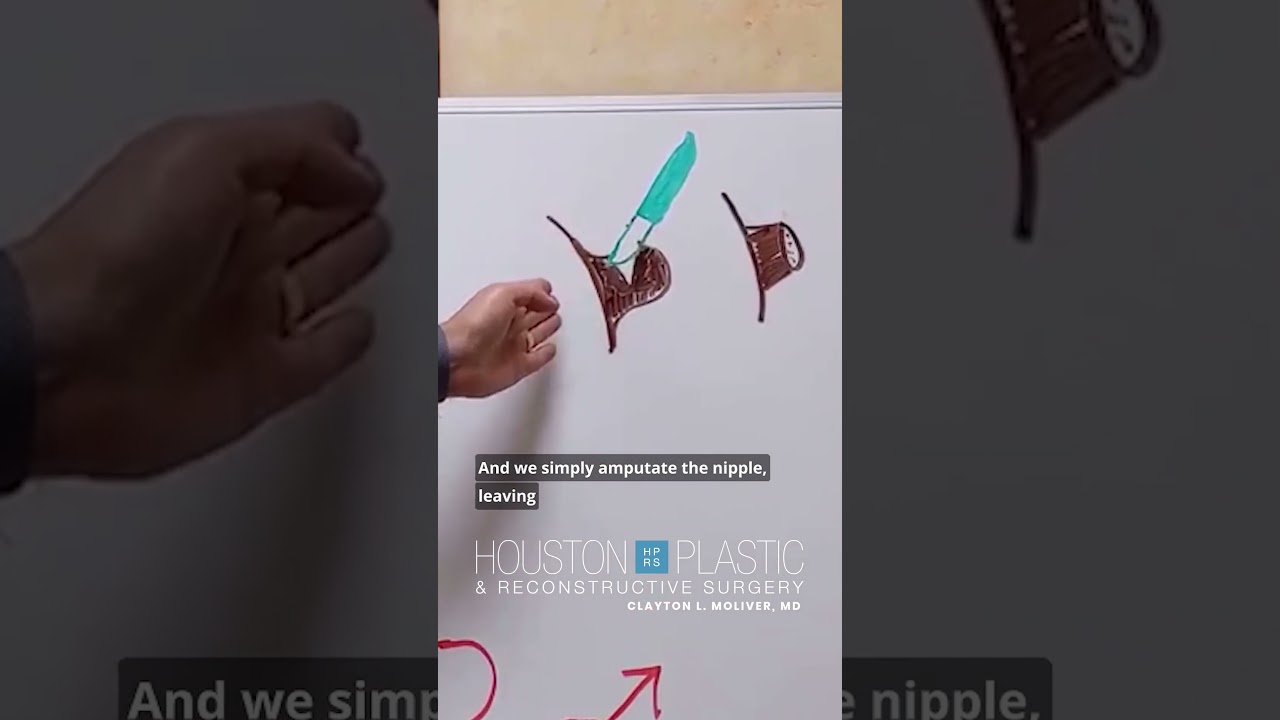 Nipple reduction surgery. This is how I do it. #plasticsurgeon