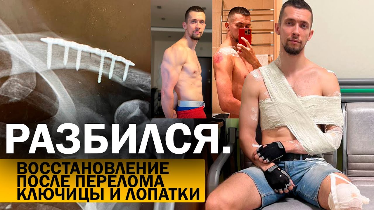 ПЕРЕЛОМ КЛЮЧИЦЫ и ЛОПАТКИ. Разбился на дороге. Восстановление, с чего начинать?