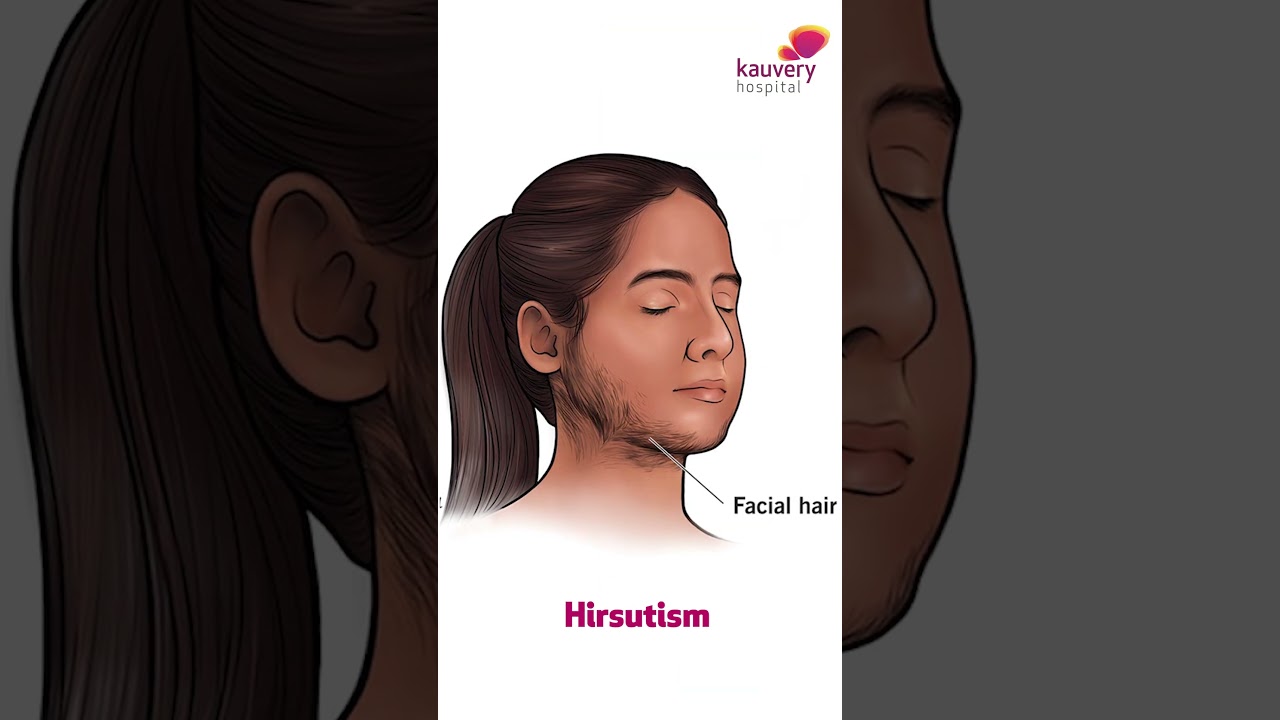 Can PCOS Cause Infertility Issues? | Kauvery Hospital Chennai | Shorts