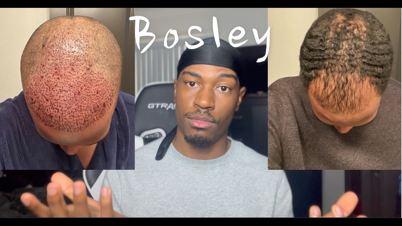 Why I chose Bosley + Hair Reveal (1 Month) & What I'm Using for Growth