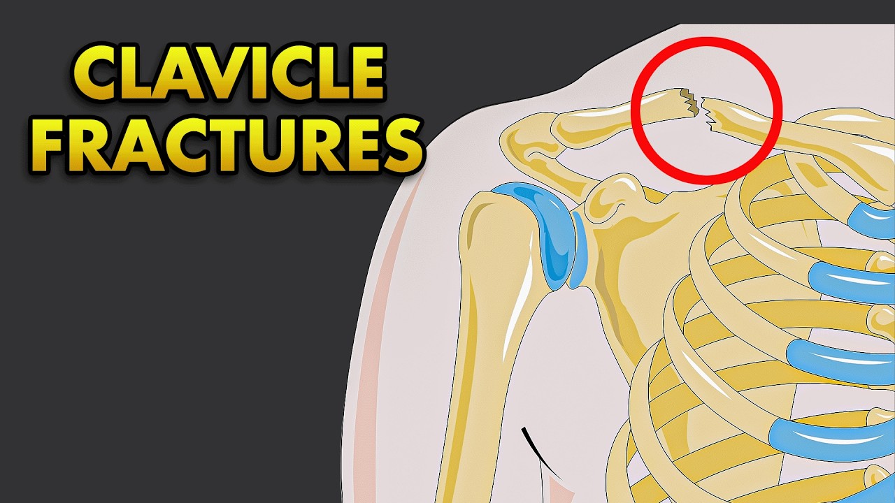 Clavicle Bone Fractures: Anatomy, Classification, Clinical Features and Treatment