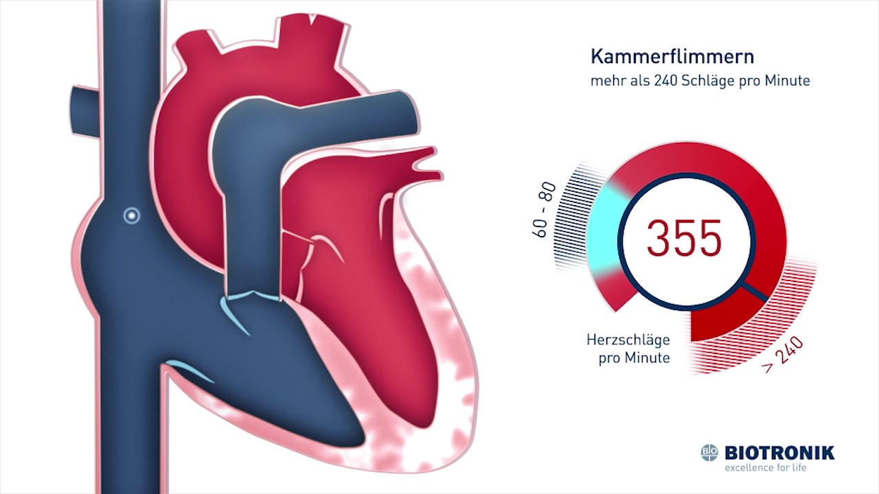 Kammerflimmern & pl&ouml;tzlicher Herztod (Animation)