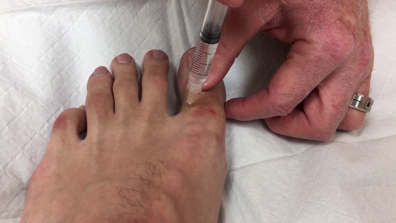 Local anesthesia in big toe for ingrown toenail removal