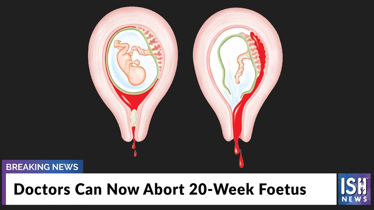 Doctors Can Now Abort 20-Week Foetus