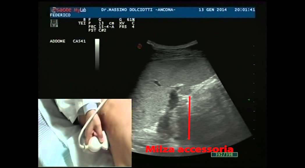 Milza accessoria