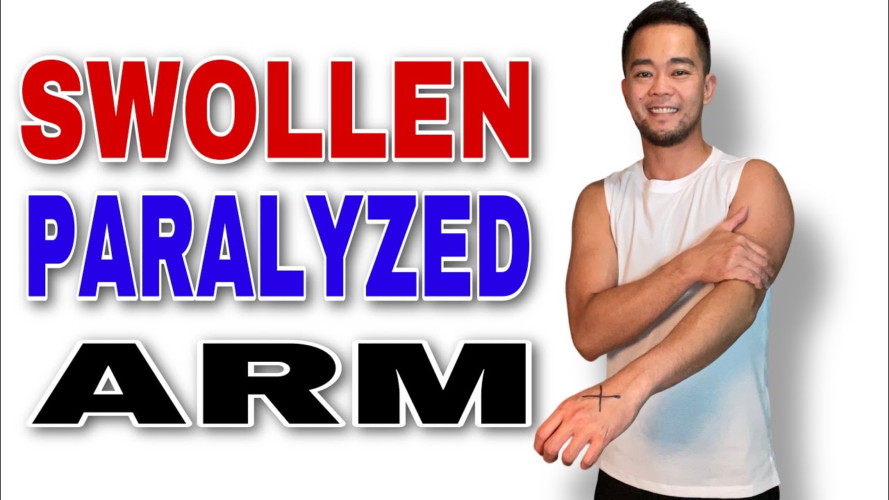 How to Massage Your Arm for Swelling After Stroke (Edema Treatment)