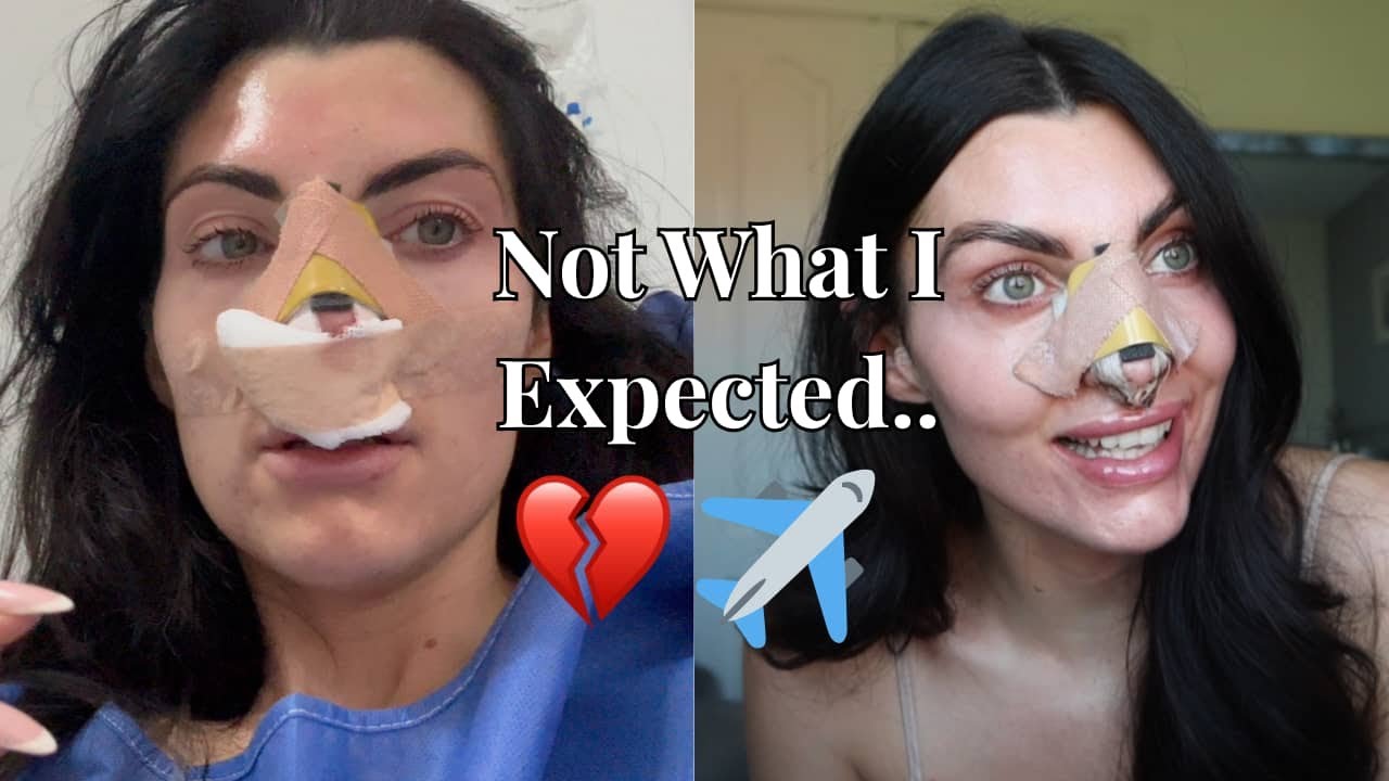 Nose Job Gone Wrong? Why I Had to Leave Australia for a Revision Rhinoplasty. VLOG & FULL STORY