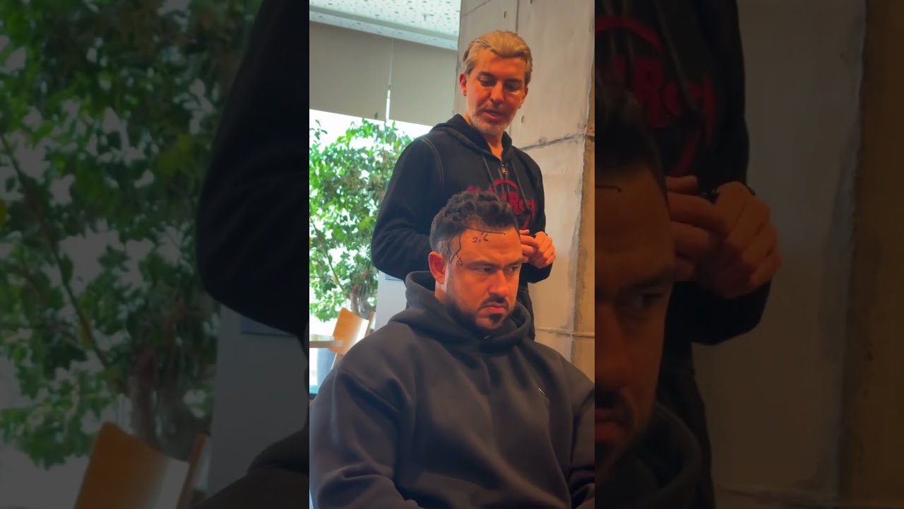Before the hair transplant operation. Consultation process. 🤩✨#hairtransplant #drserkanayginclinic