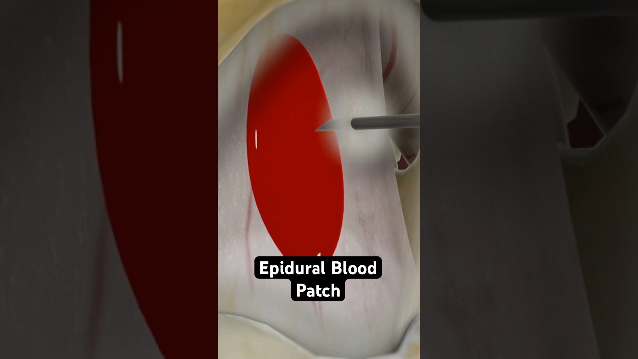 Patching a leaky spine - with blood! (3D Animation)