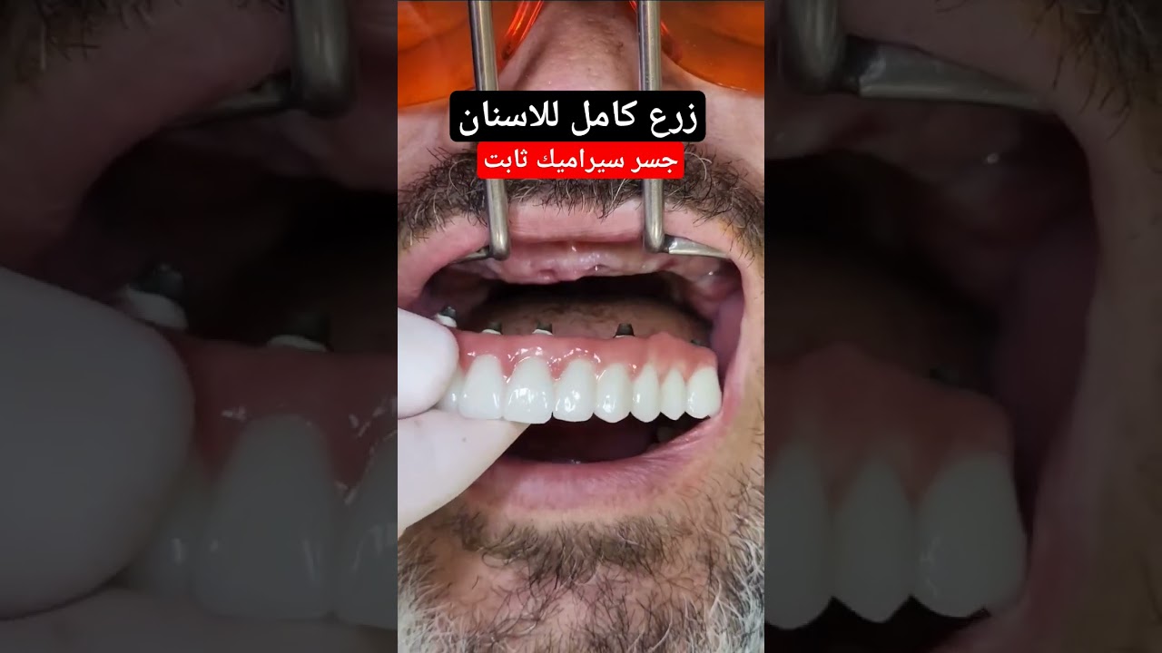 زرع اسنان لكامل الفم وتركيب جسر سيراميك ثابت