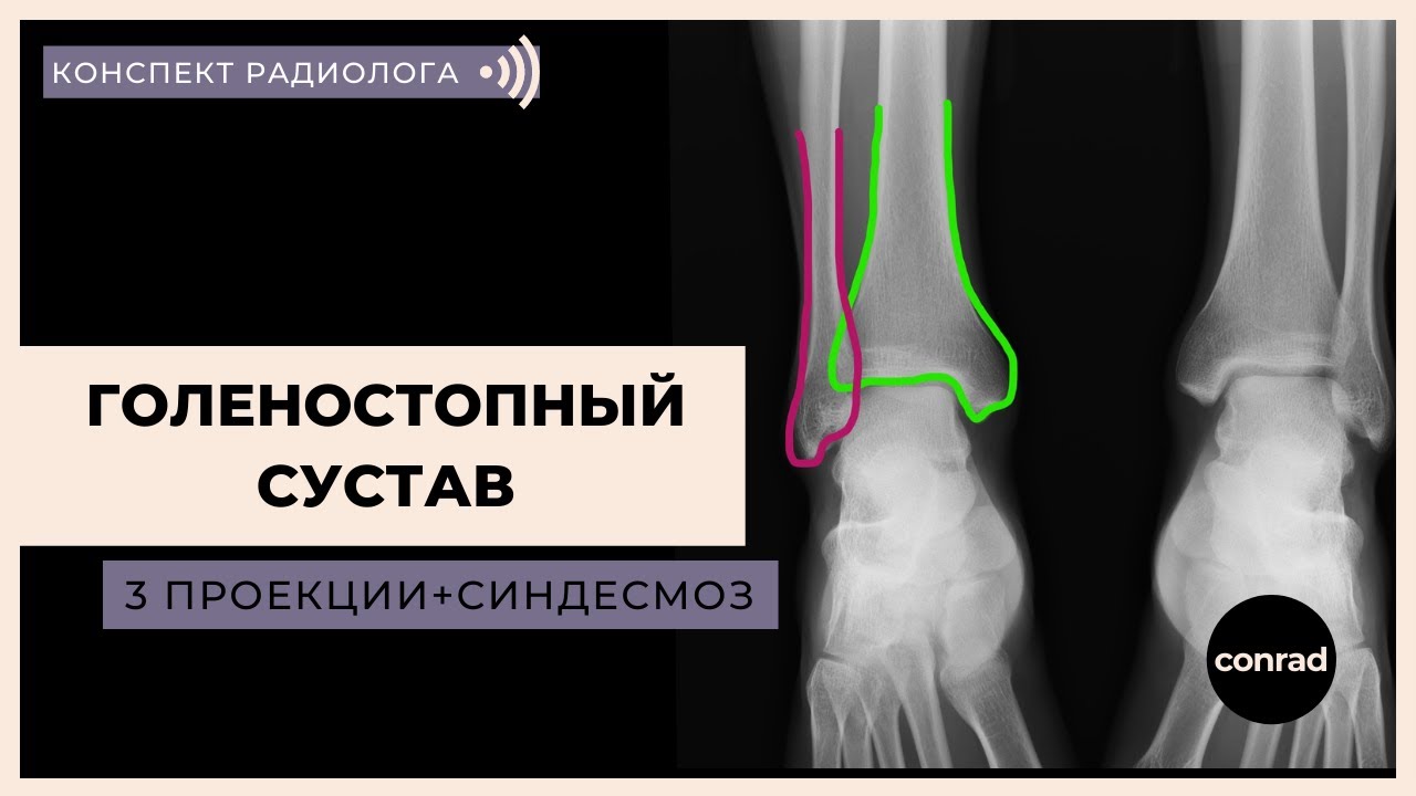 РЕНТГЕН-АНАТОМИЯ ГОЛЕНОСТОПНОГО СУСТАВА