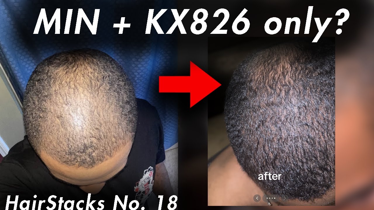 Восстановление после выпадения волос с помощью миноксидила/KX826: нет FIN? @minoxkings | Подкаст ...