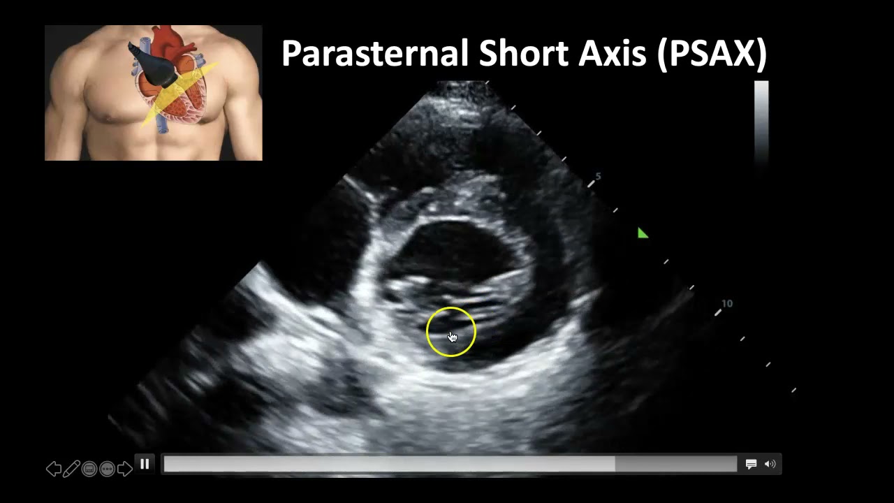 Cardiac Ultrasound: Basic Windows and Anatomy