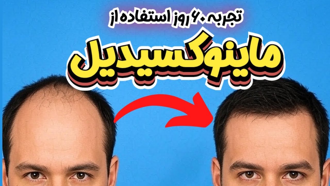 تجربه استفاده از ماینوکسیدیل