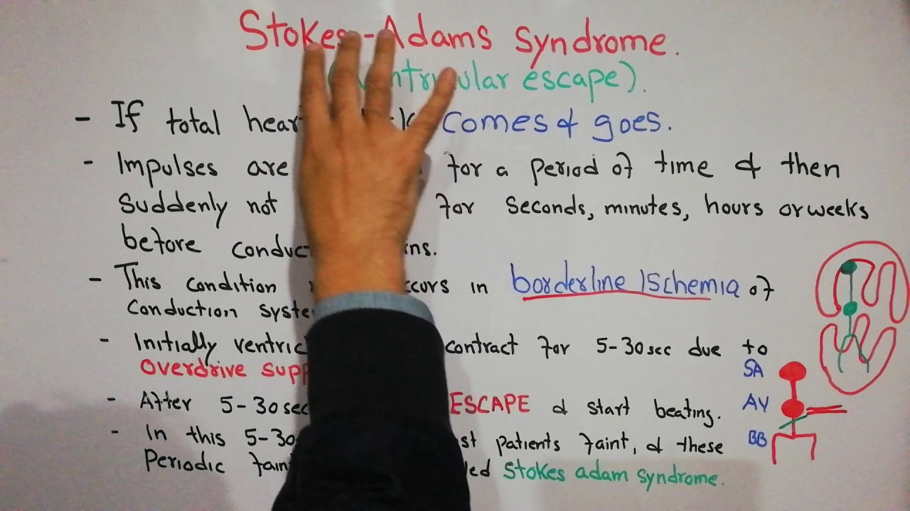 CVS physiology 51. Stokes adams syndrome, Ventricular escape, overdrive suppresion