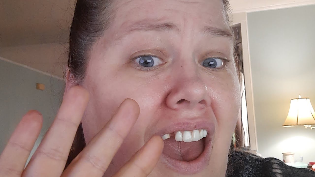 Aspen Dental -4th Broken tooth in 5 Months! #aspendental #dentures #denturewearer #denturelife