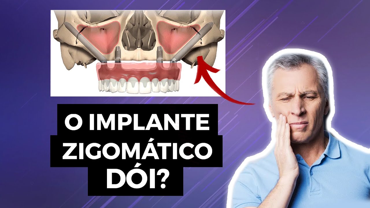 O Implante Zigom&aacute;tico D&oacute;i?