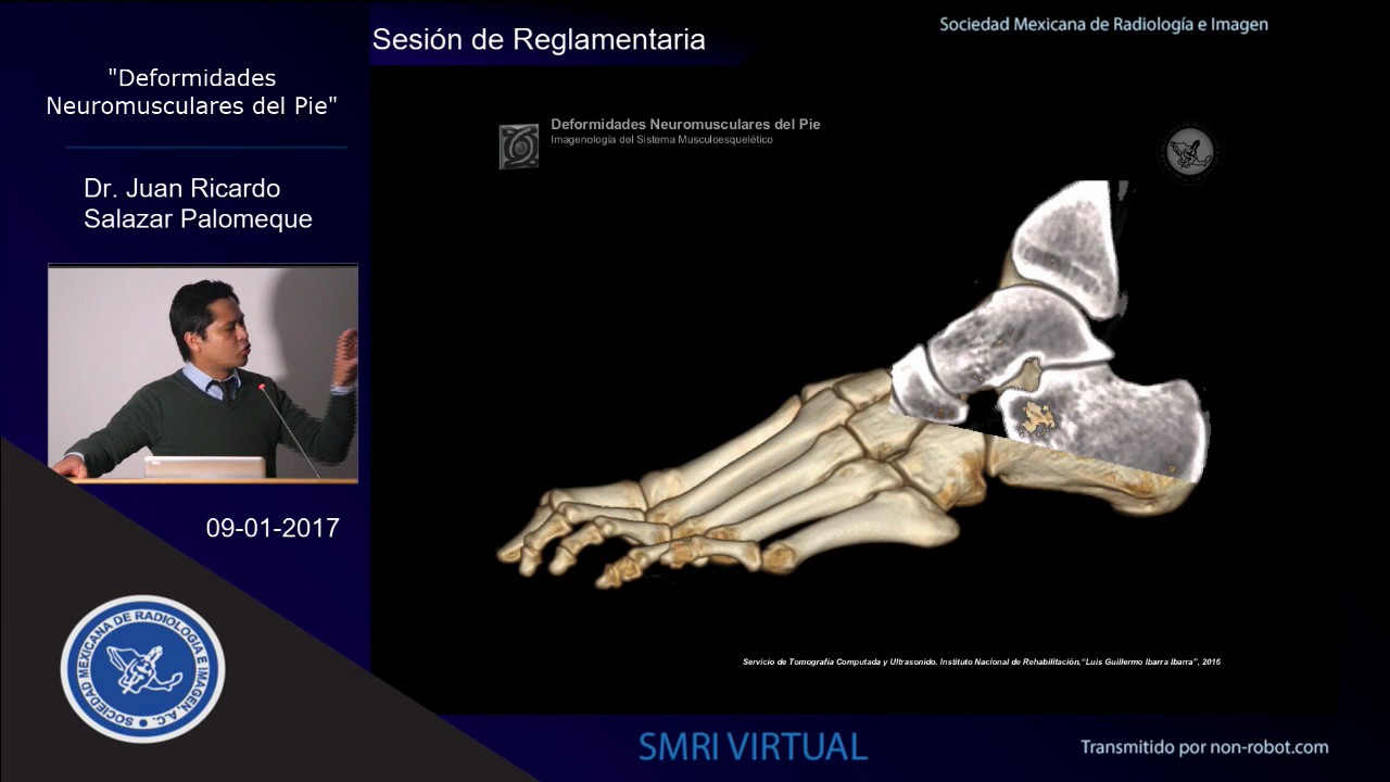 Deformidades Neuromusculares del pie