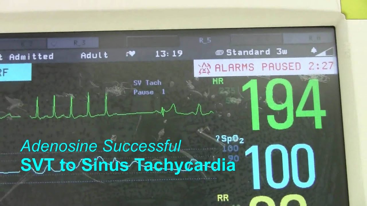 SVT or Supraventricular Tachycardia