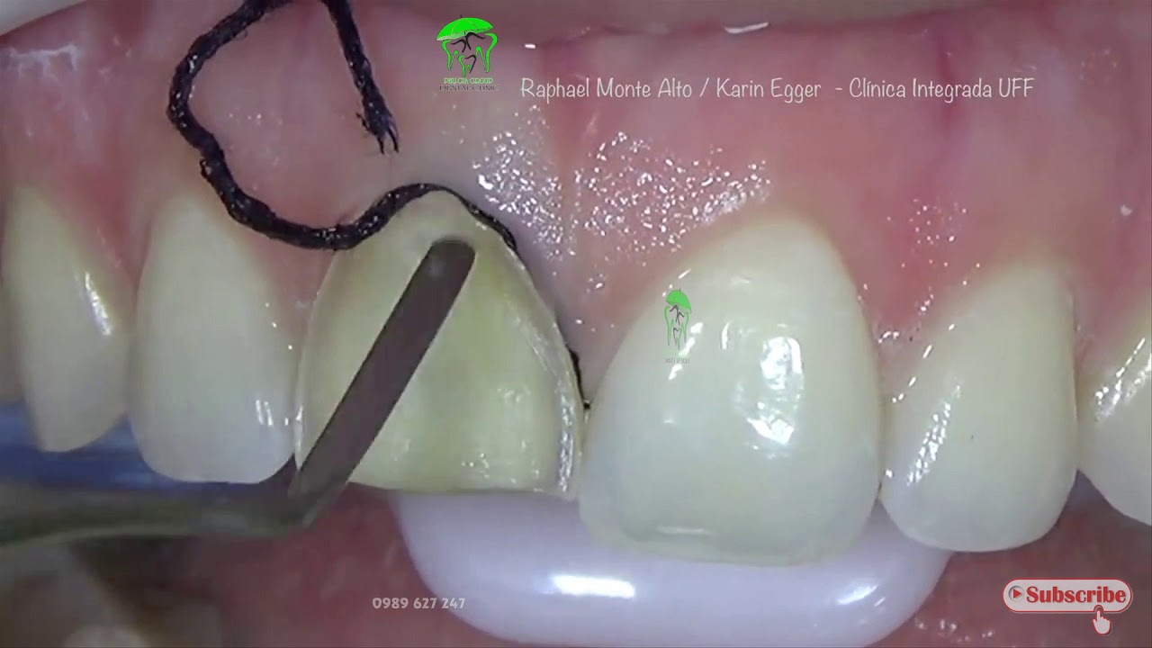 PHƯƠNG PHÁP MÀI RĂNG DÁN VENEER  II NK PHU GIA GROUP 0989 627 247 NHẬT ANH