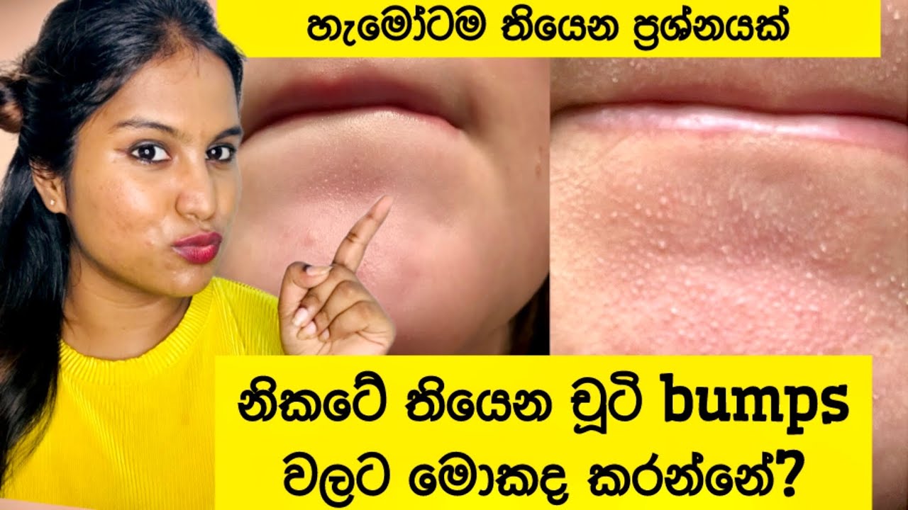 ඔයාගෙත් මේ වගේ නම් මෙන්න විසදුම | chin bumps | මොකද කරන්නේ  #vlog #vlogger #visulifestyle #skincare