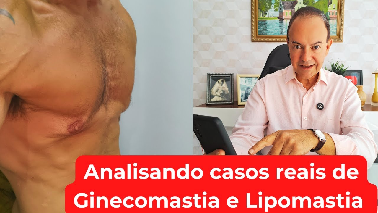 Analisando casos reais de Ginecomastia e Lipomastia #11 [Dr. Jacintho - Cirurgião Plástico]