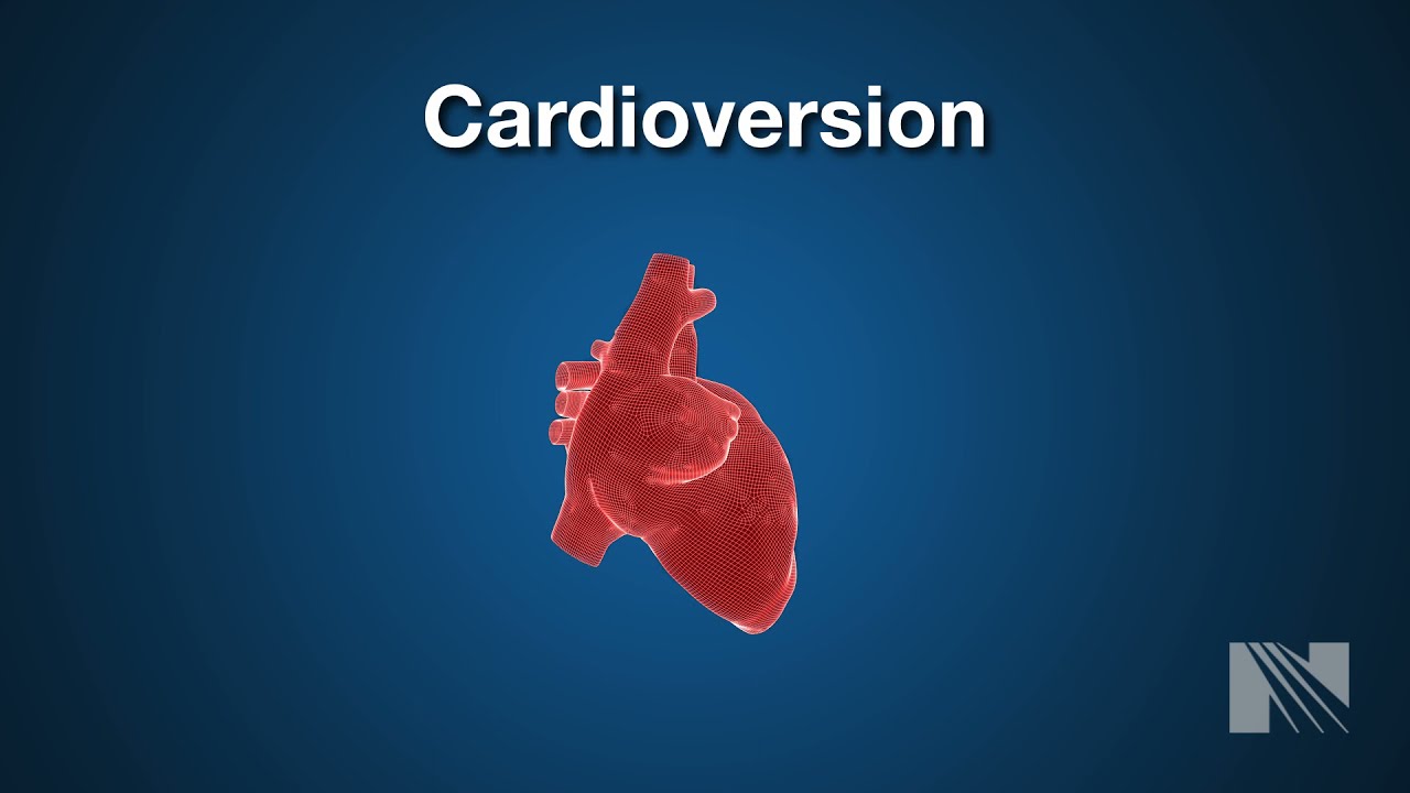 Cardioversion Procedure: Returning a heartbeat to normal rythm