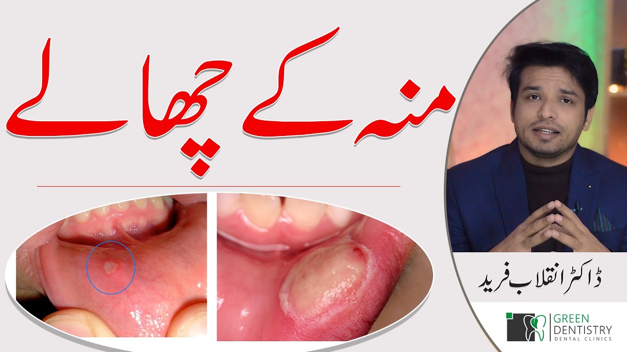 Mouth Ulcers | Oral Ulcers | Causes | Home Treatment | Prevention | Dr. Inqalab F | Urdu | Hindi