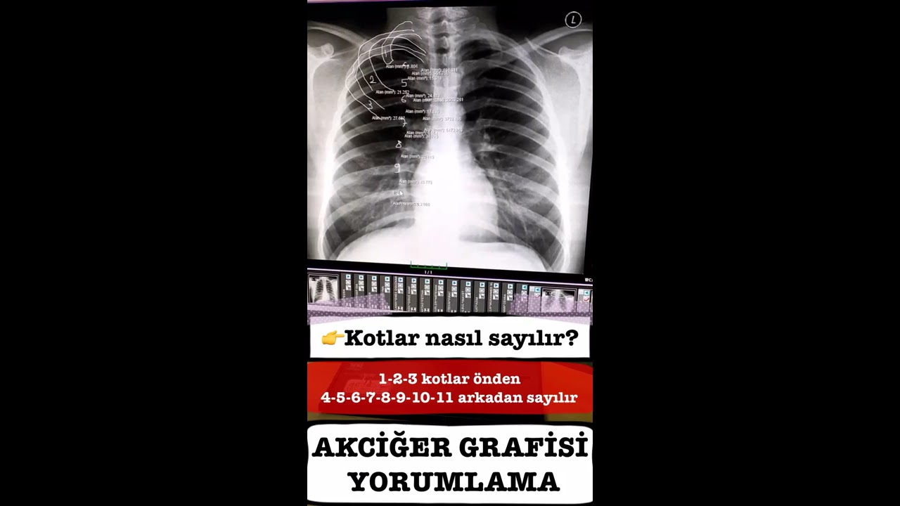 AKCİĞER GRAFİSİ YORUMLAMA