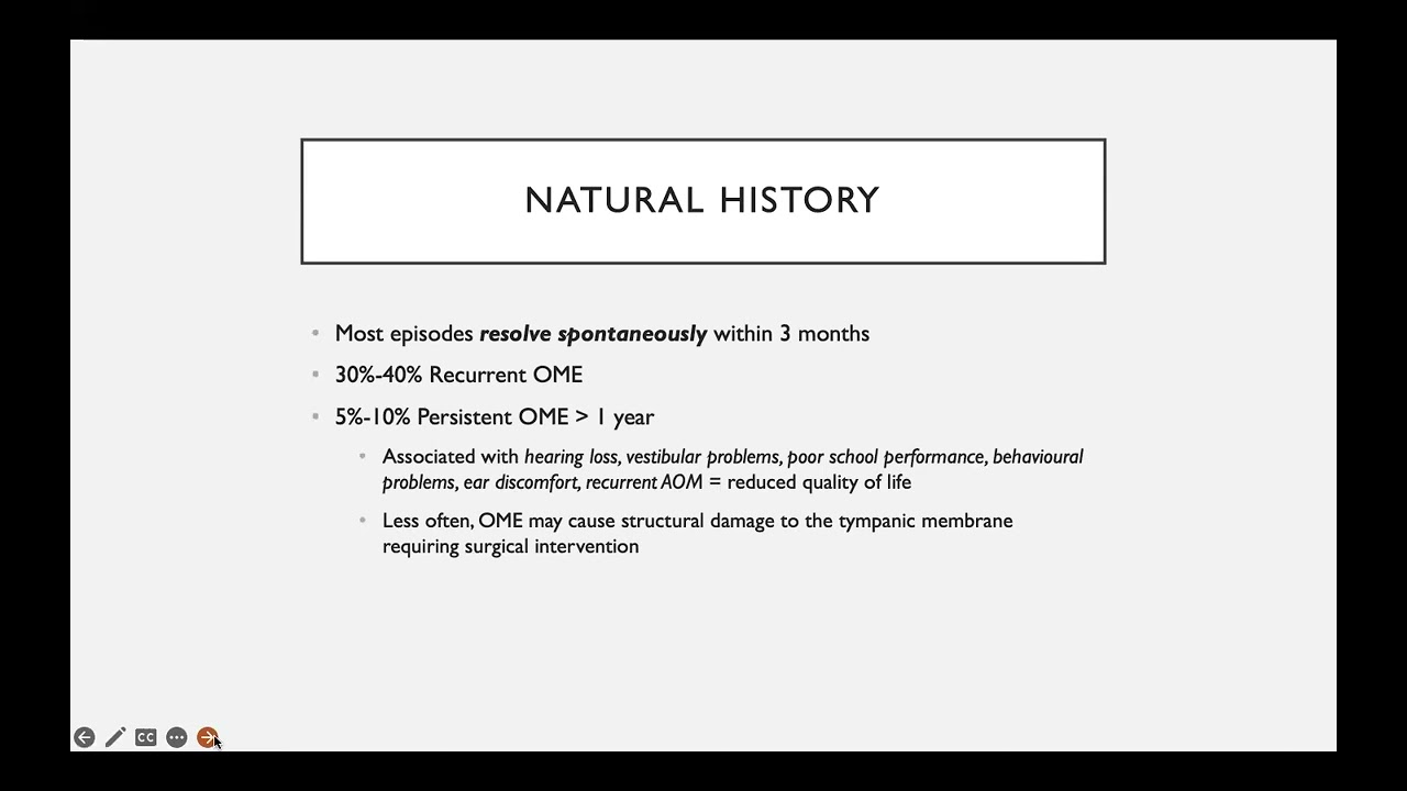 Paediatric otitis media with effusion- Dr Leila Mahomed
