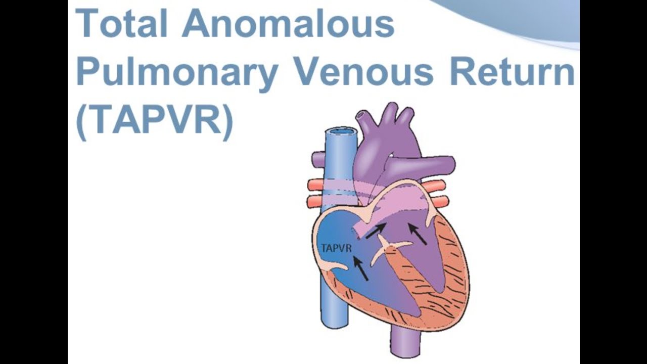 Total Anomalous Pulmonary Venous Return (TAPVR)